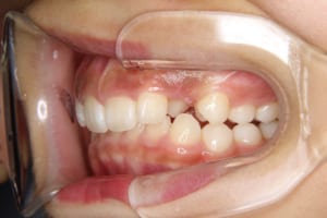 上の犬歯が口蓋側に生えています
